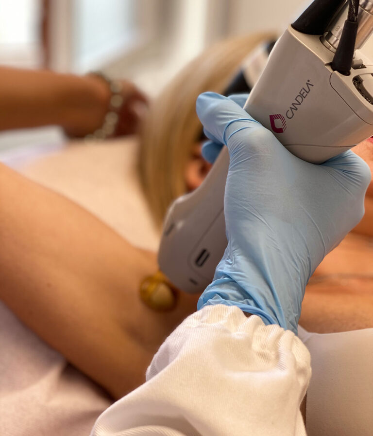 Epilazione Laser Ascelle