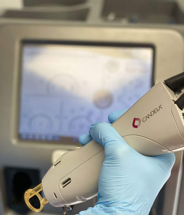 Epilazione Laser Viso